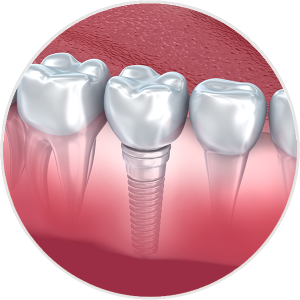 Dental Implant Graphic